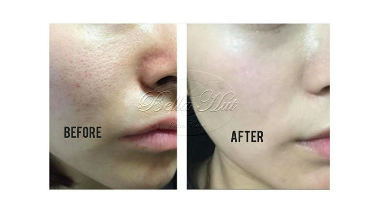 hyaluronic acid soap benefits